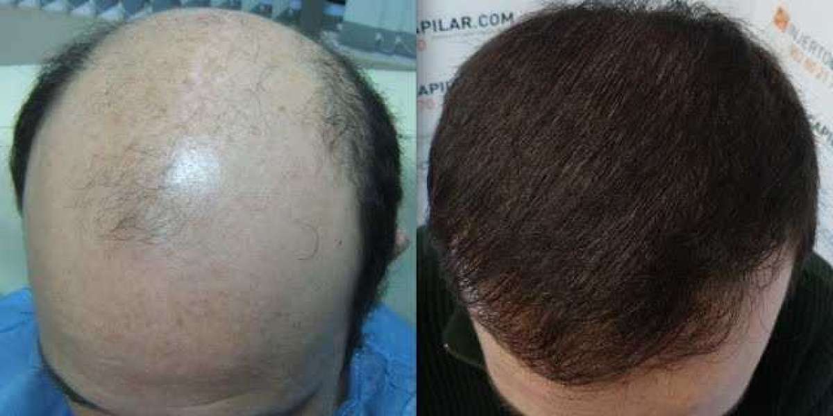 Cuanto Cuesta Un Injerto De Pelo